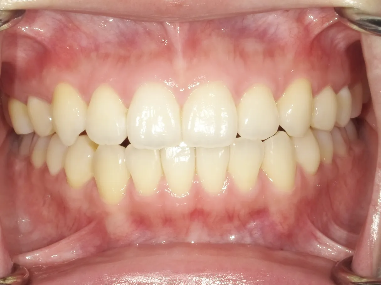 CASE15