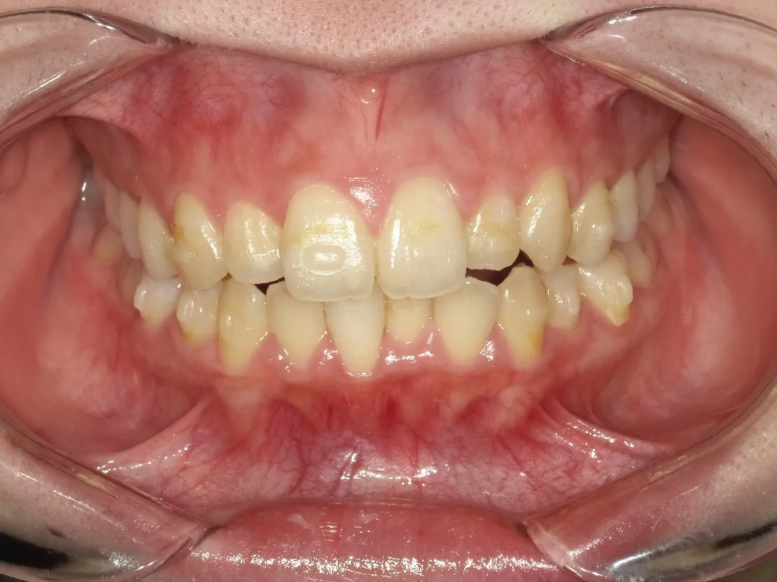 CASE04