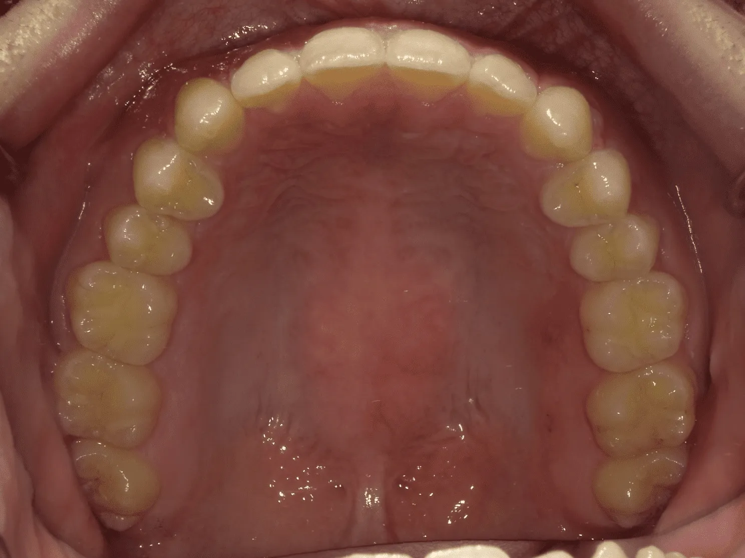 CASE12