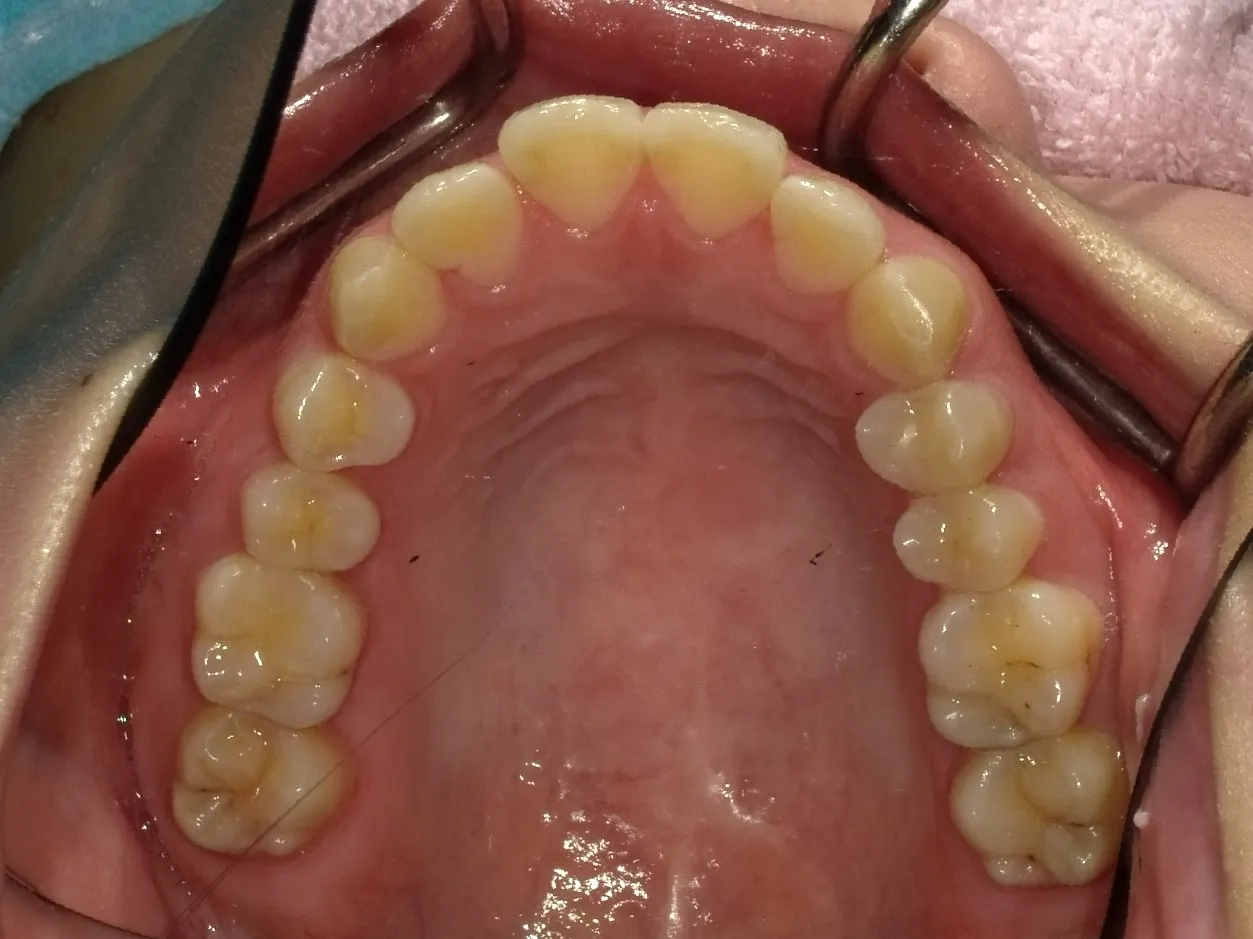 CASE11