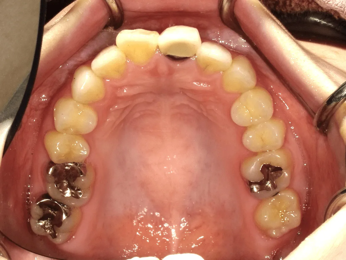 CASE15