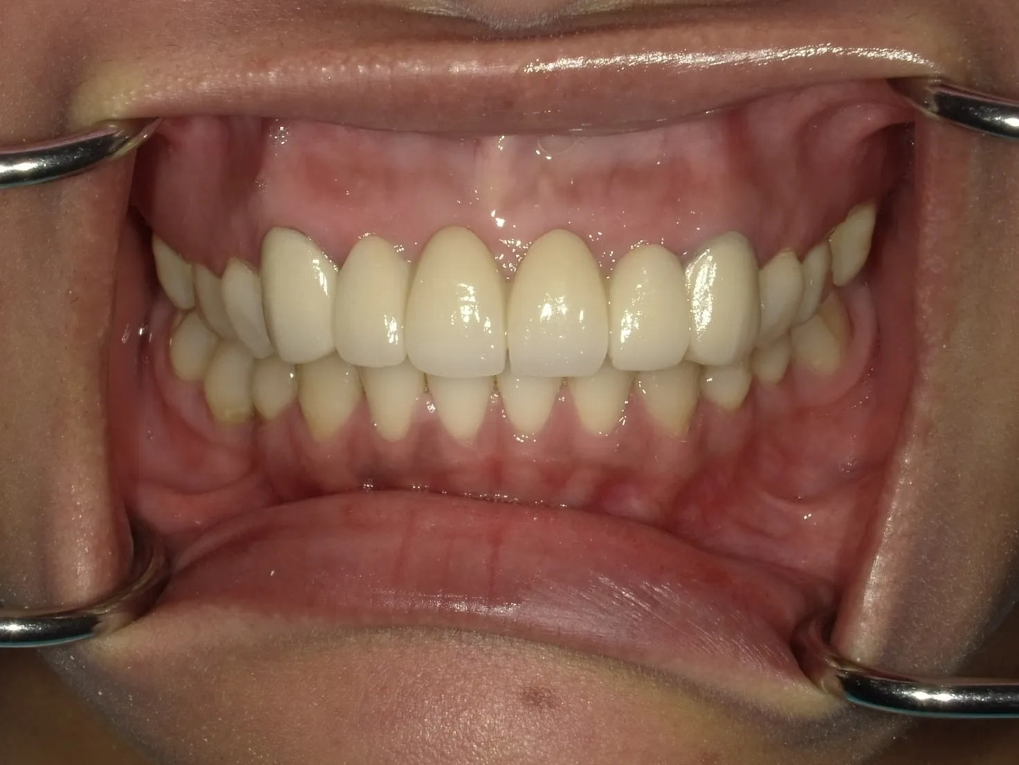 CASE18