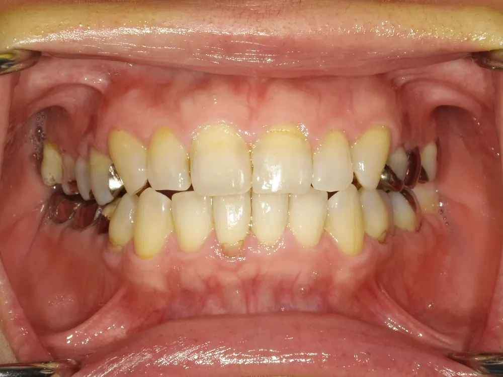 CASE14