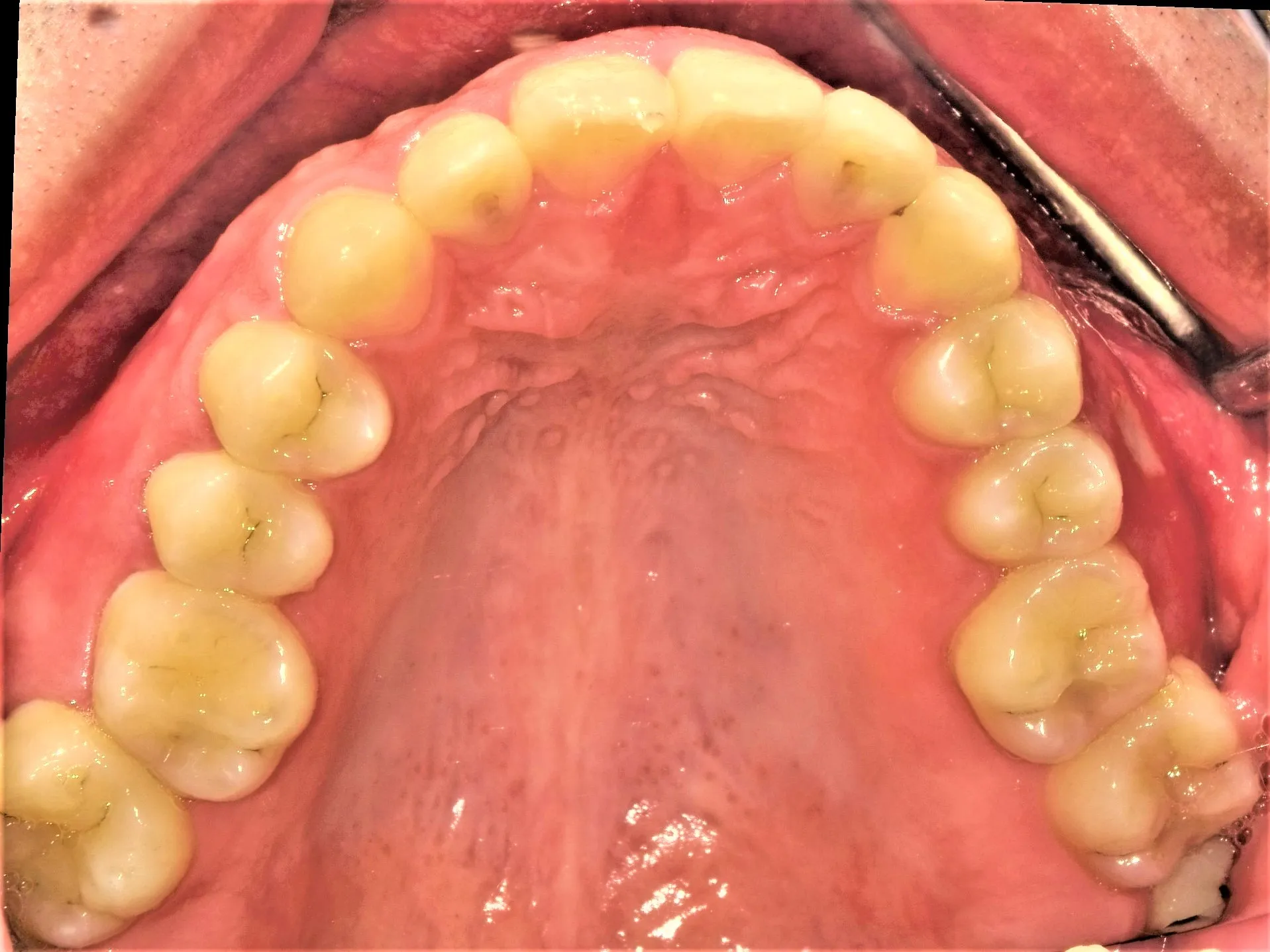 CASE19