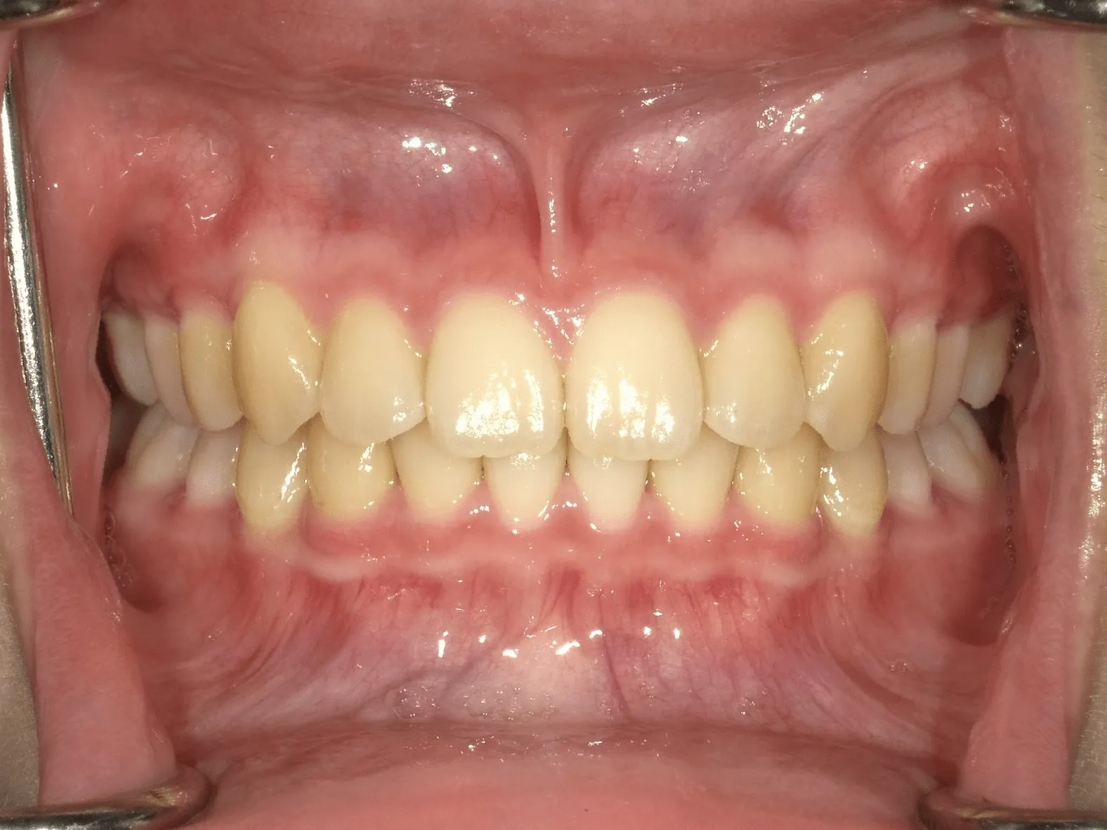 CASE12