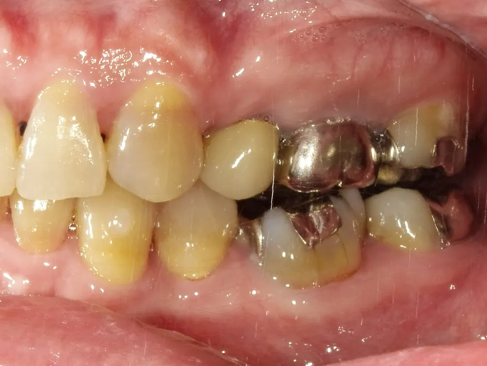 CASE13