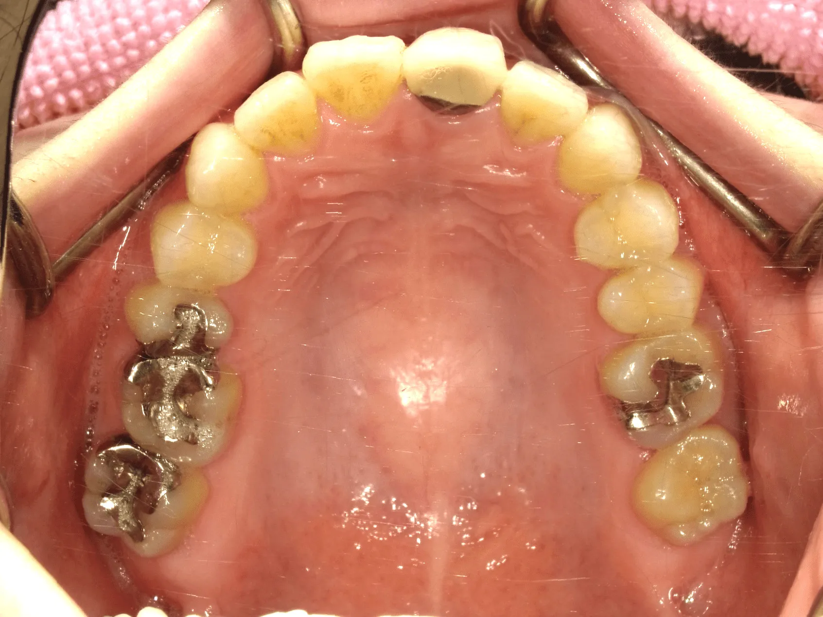 CASE15