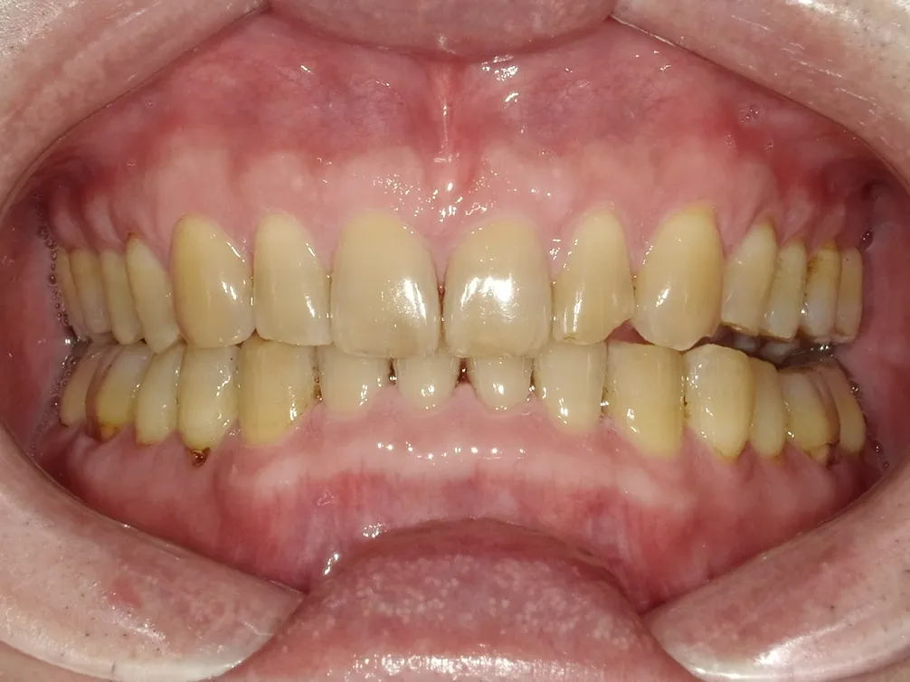 CASE13
