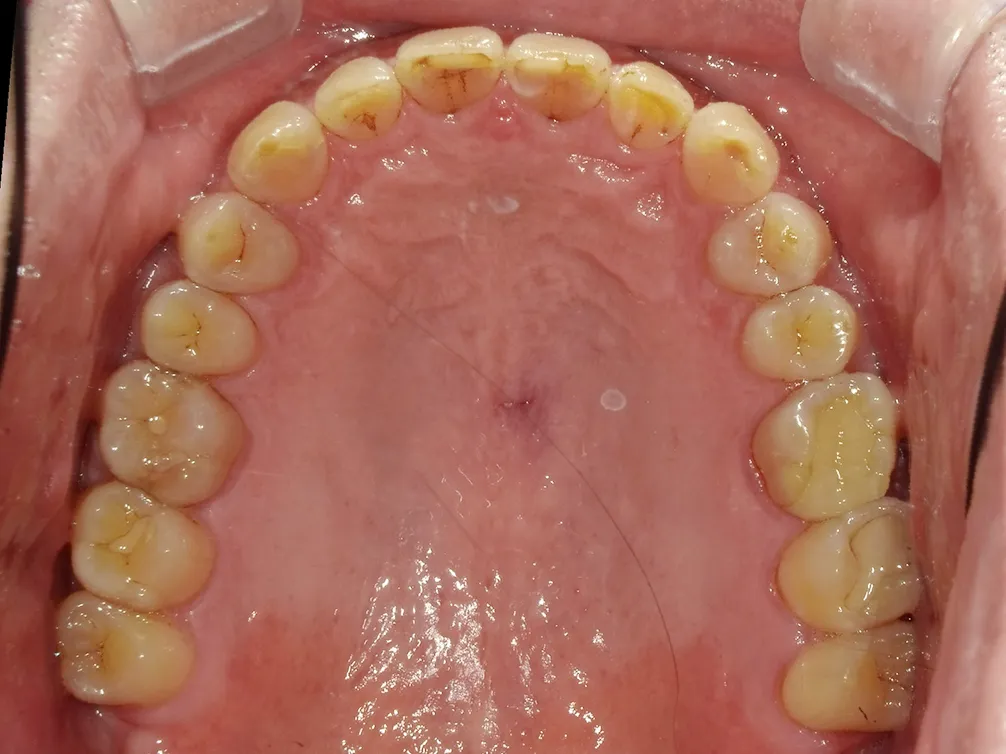 CASE13