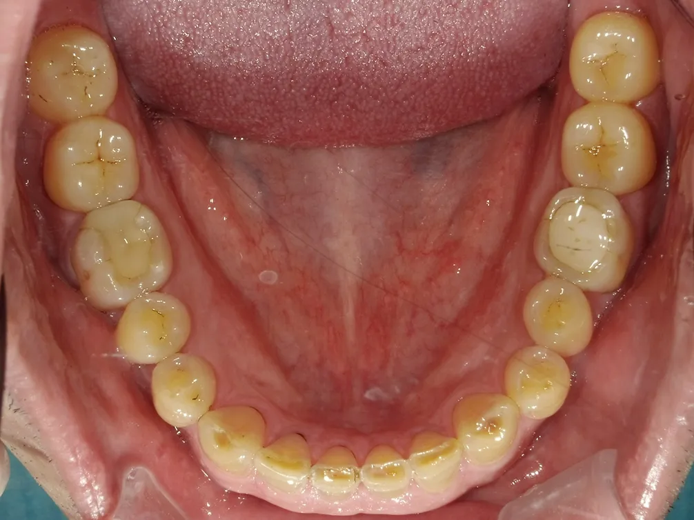 CASE13