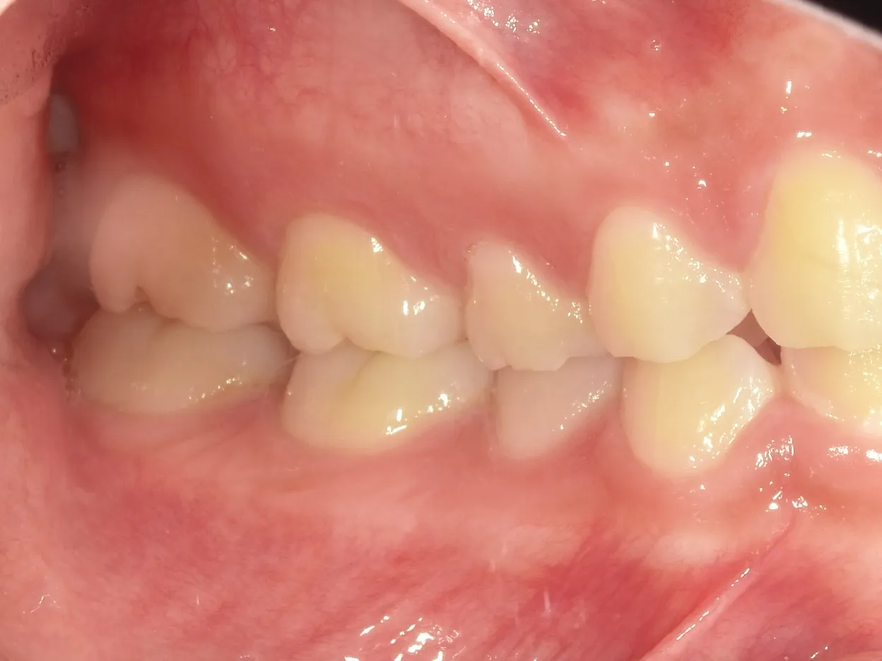 CASE21