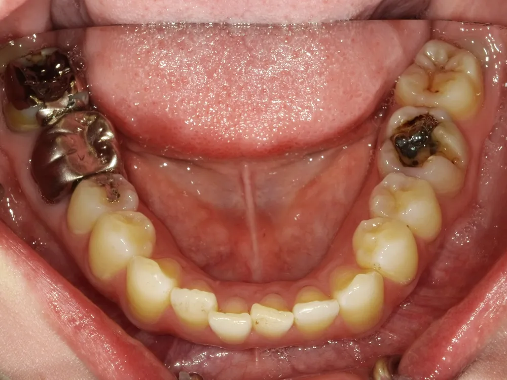 CASE13