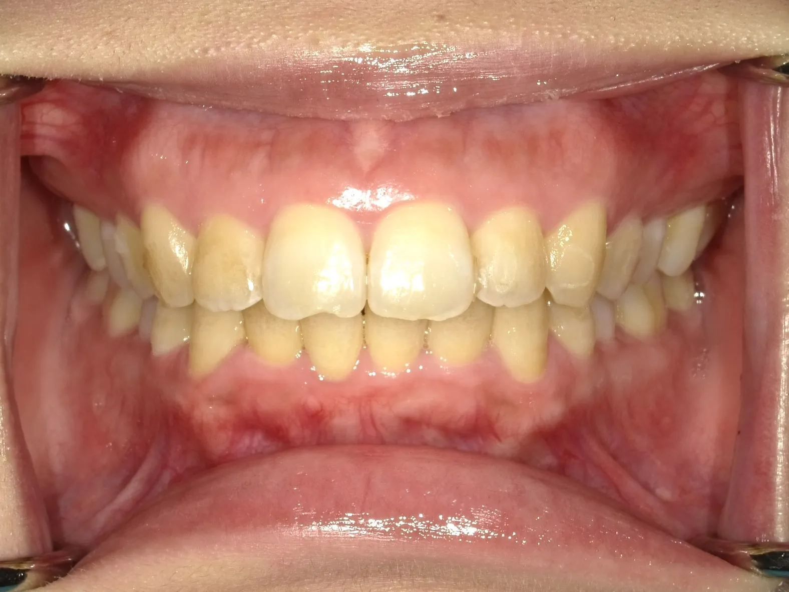 CASE14
