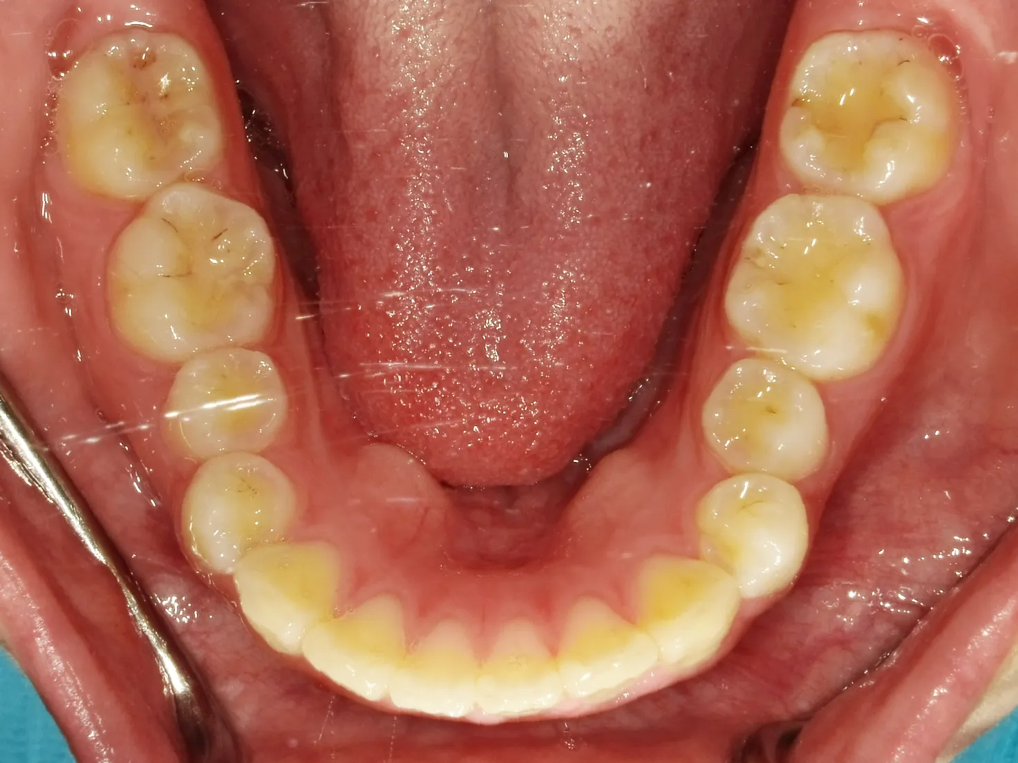 CASE21