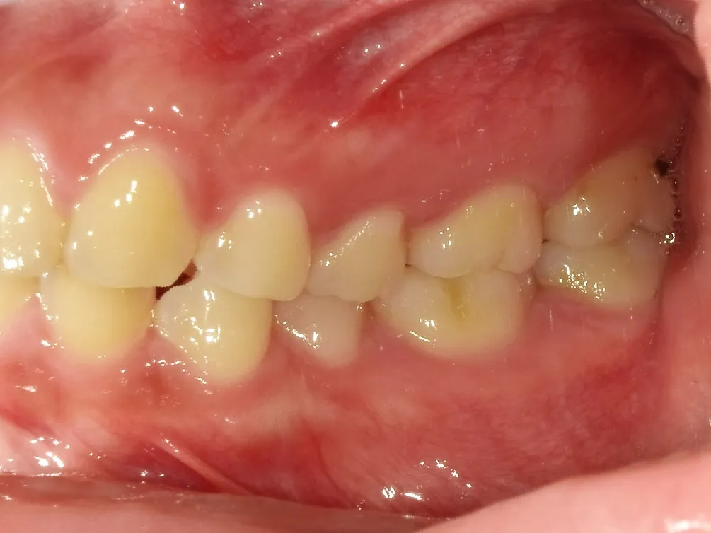 CASE21
