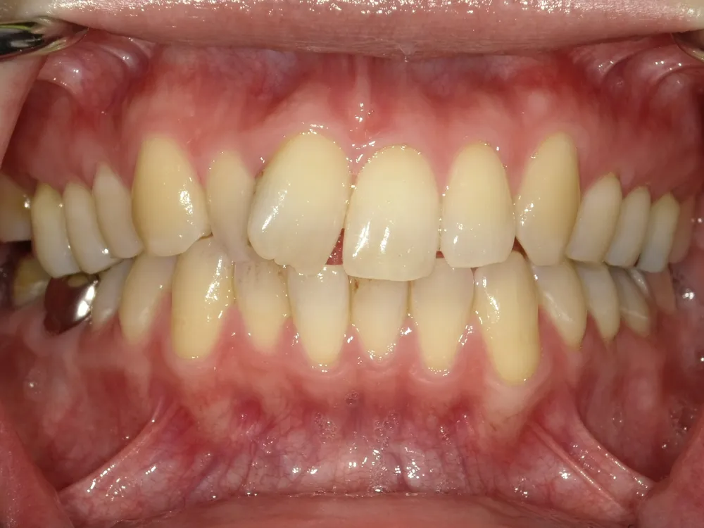 CASE15