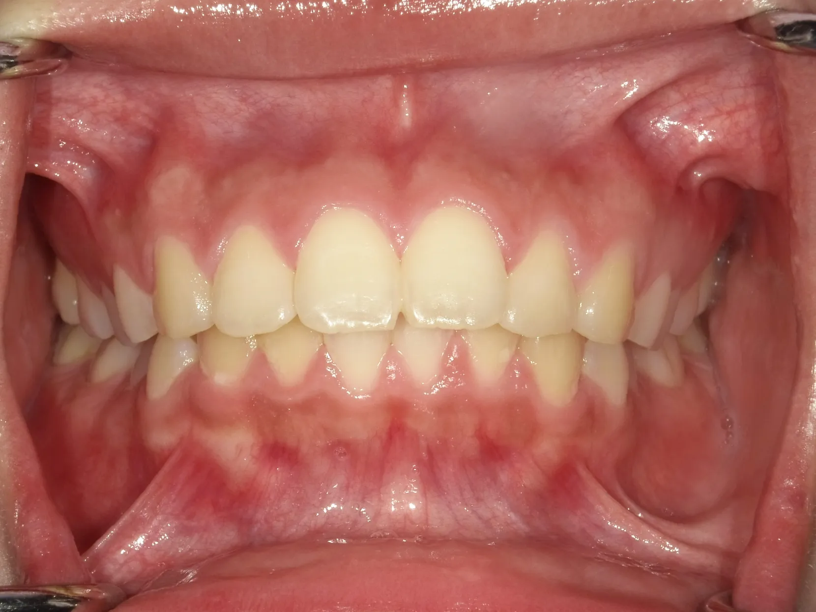 CASE21