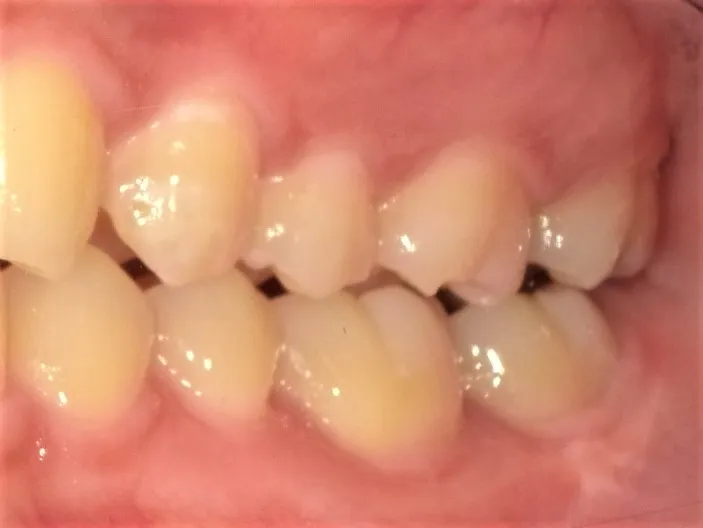 CASE21