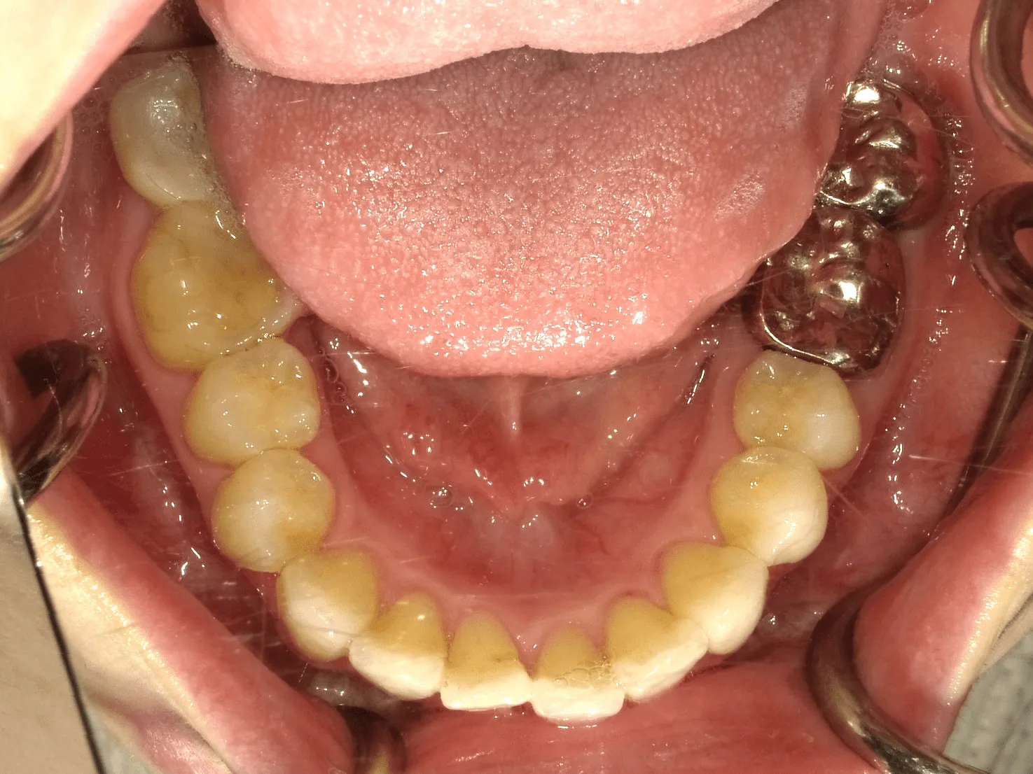 case15