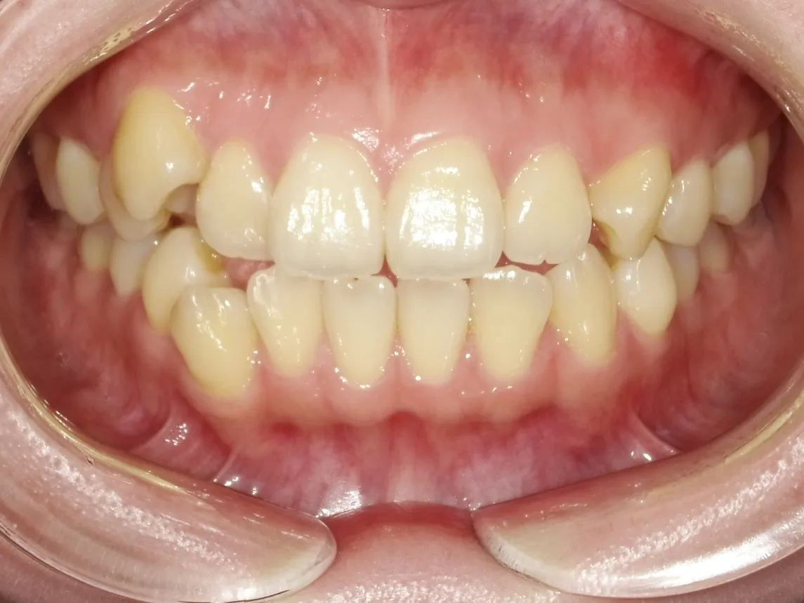 CASE15