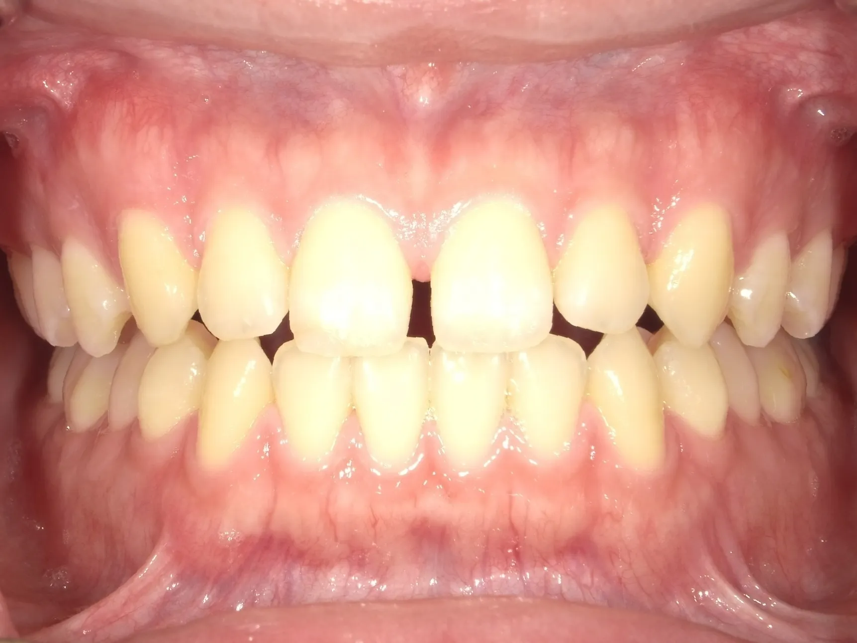 CASE15
