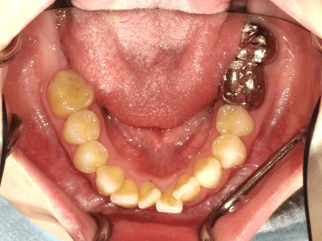 case15