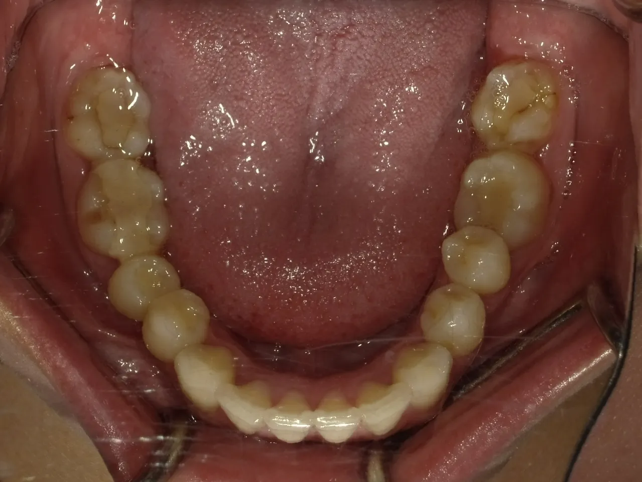 CASE18