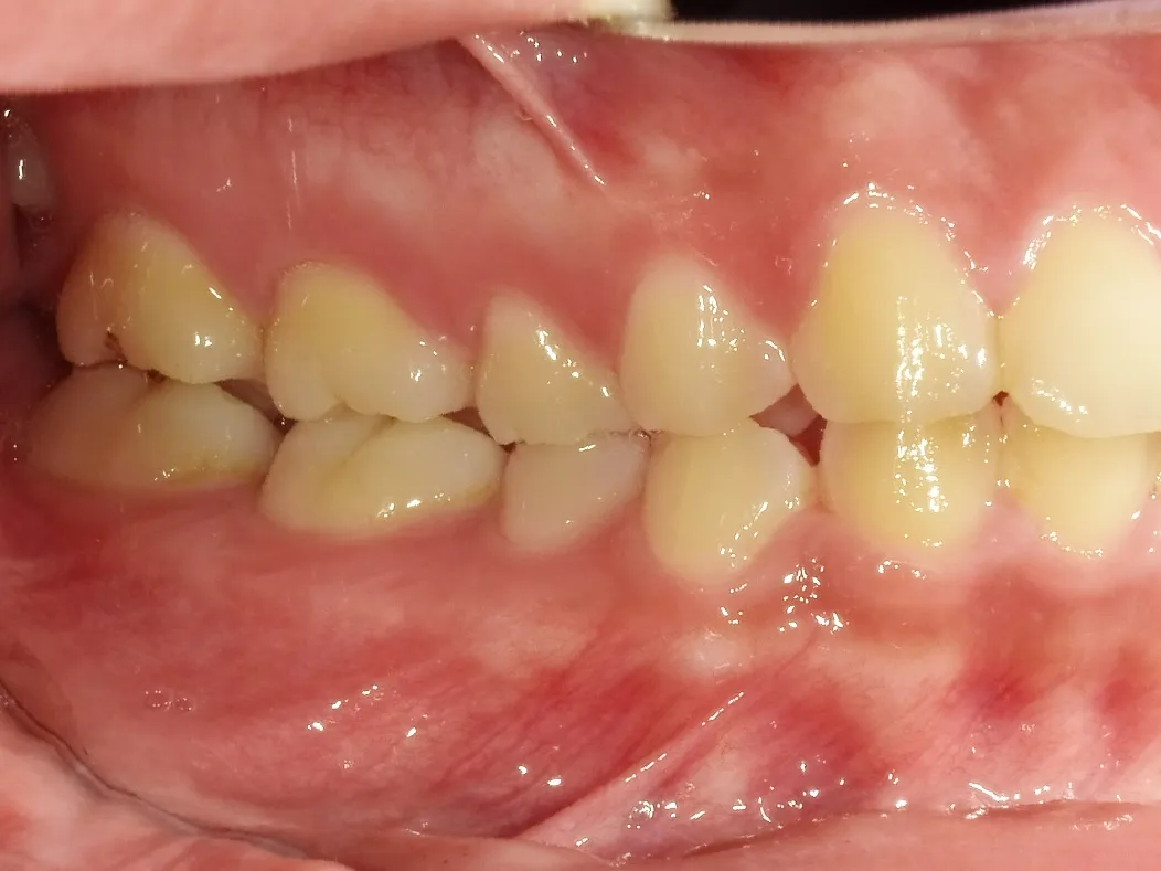 CASE21