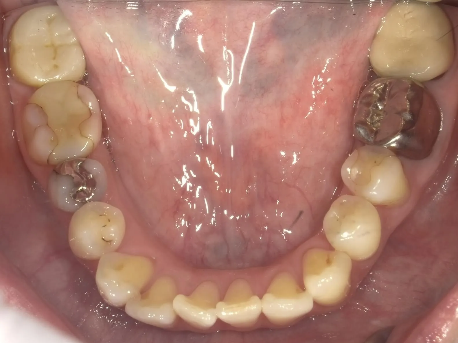CASE13