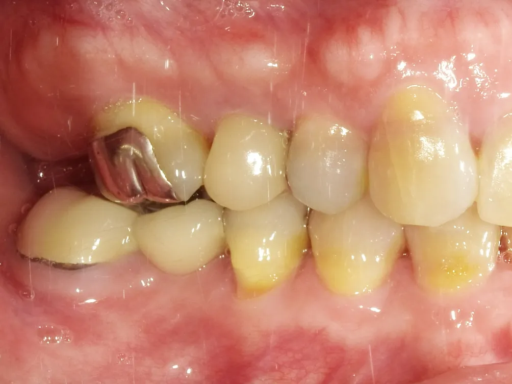 CASE13