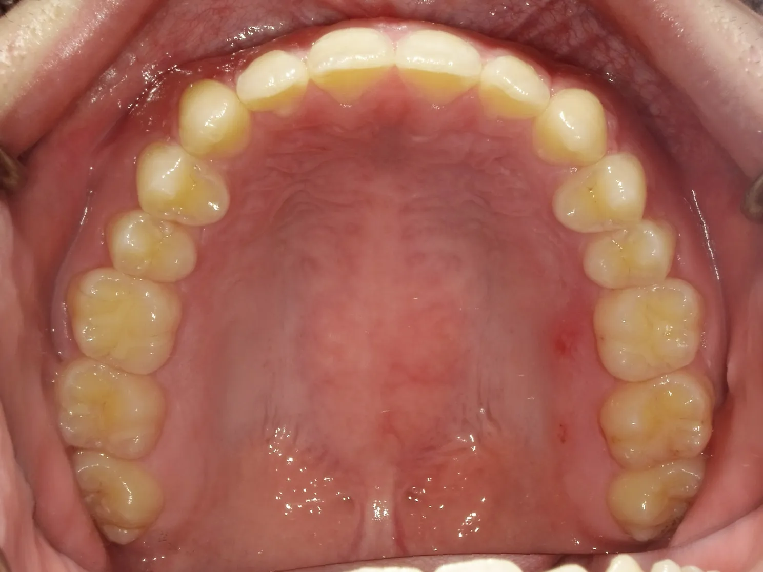 CASE13