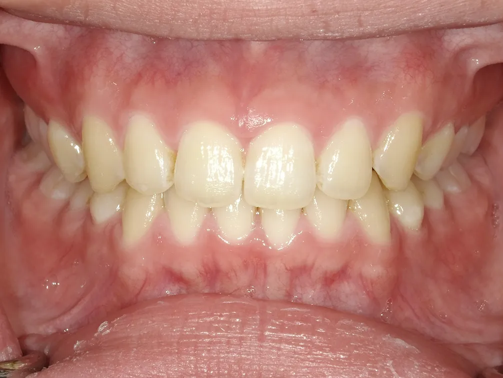 CASE12