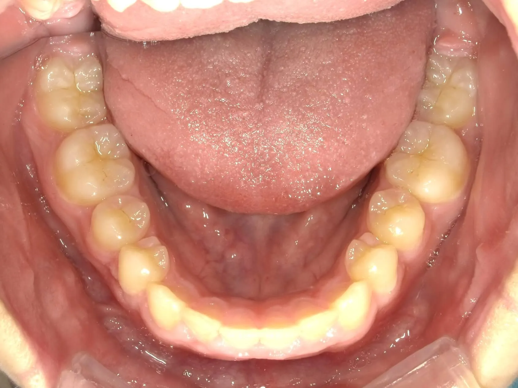 CASE04