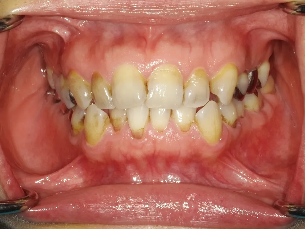 CASE14