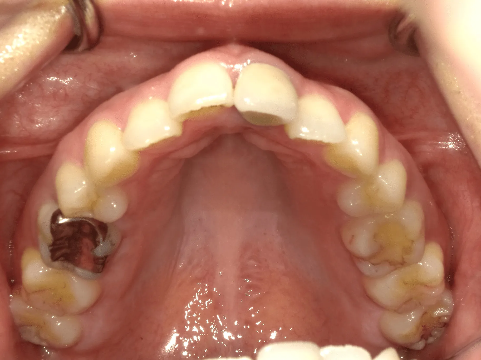 CASE16