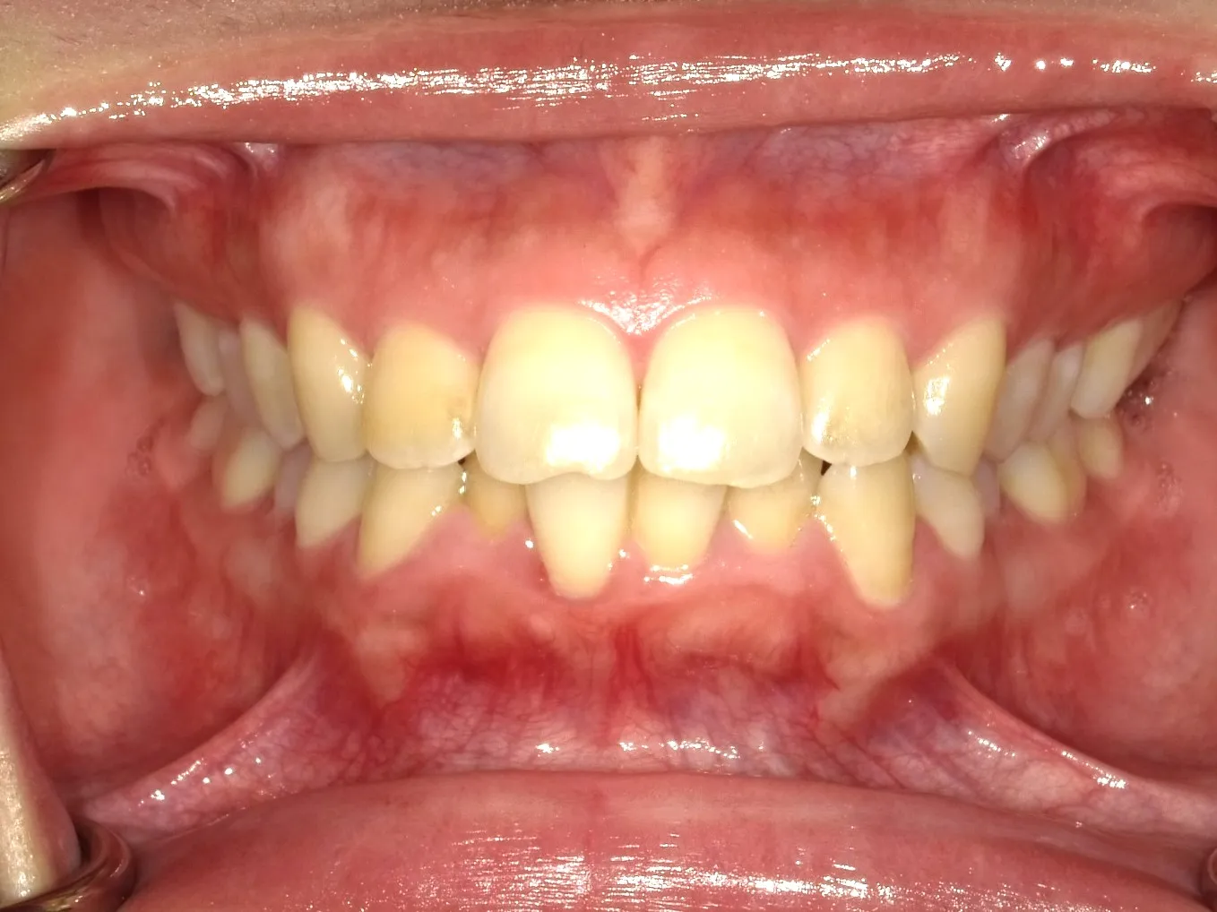 CASE14