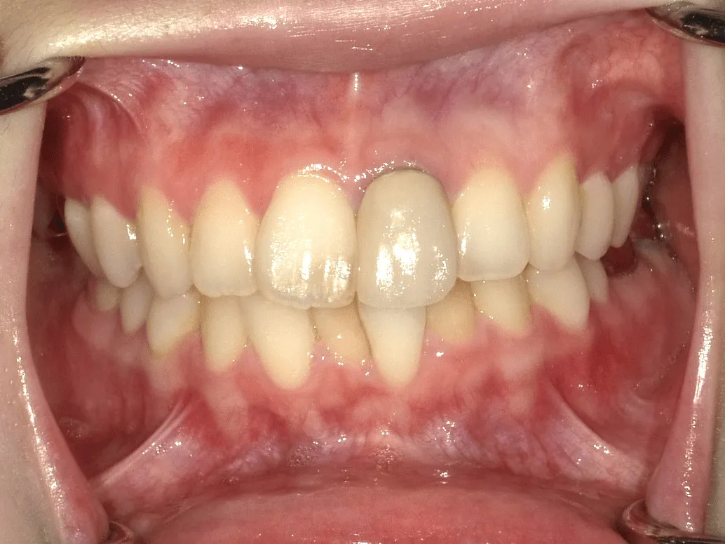 case15