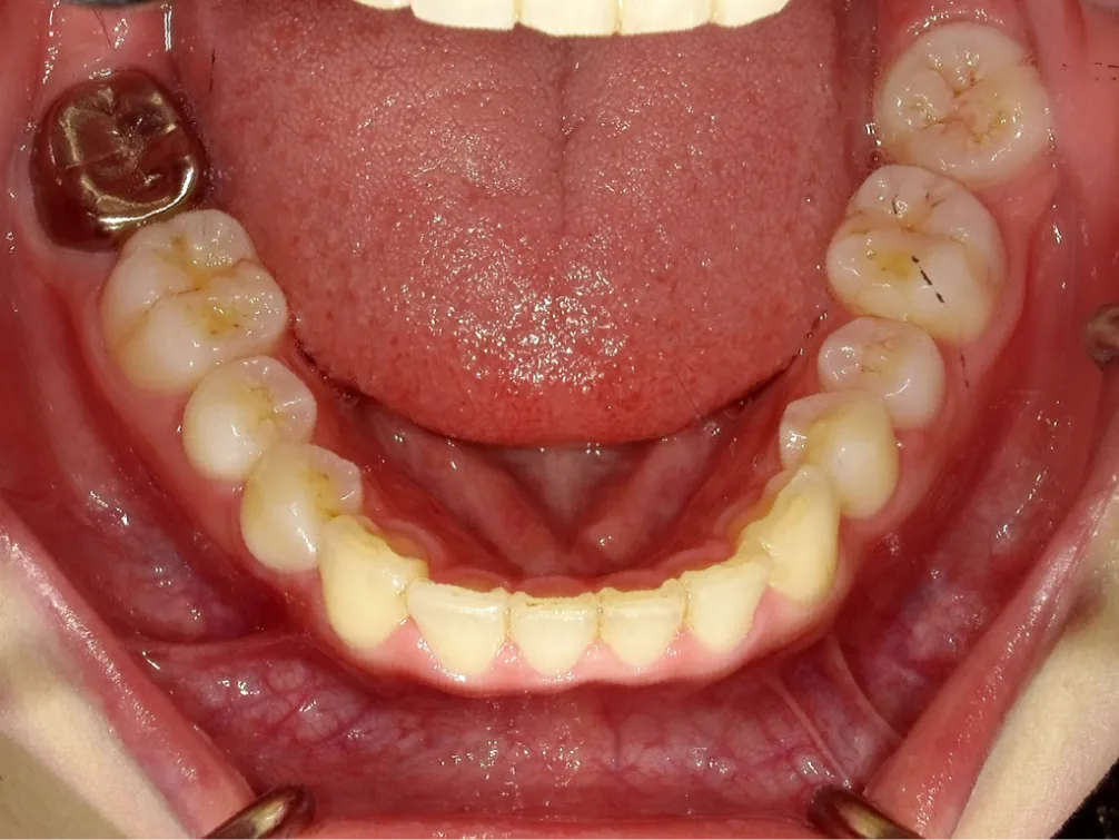 CASE06