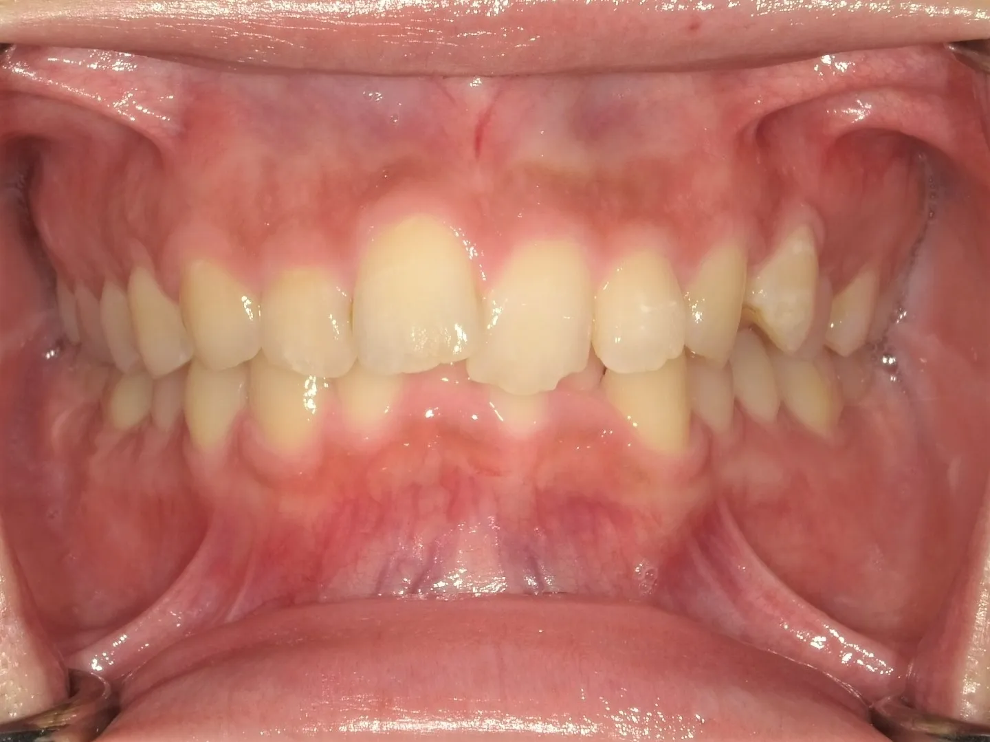 CASE21