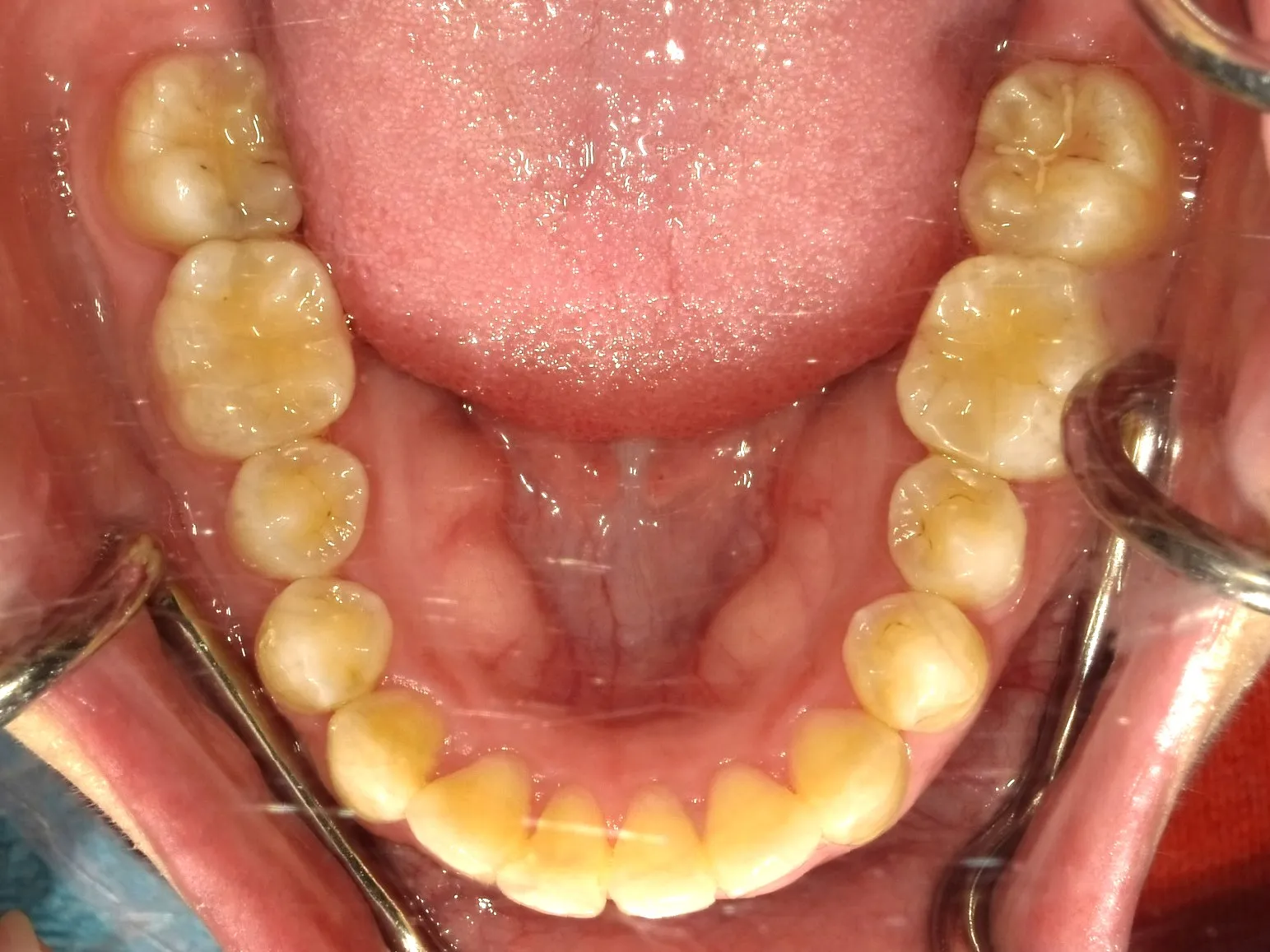 CASE14