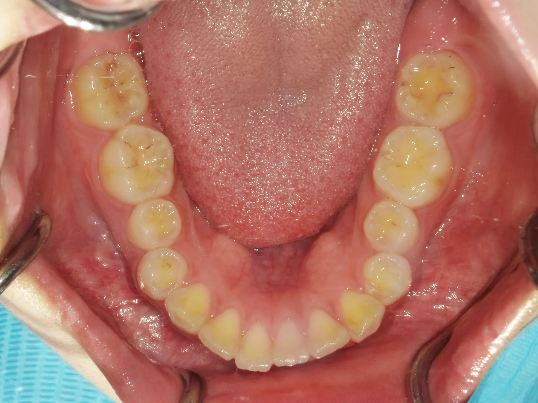 CASE21