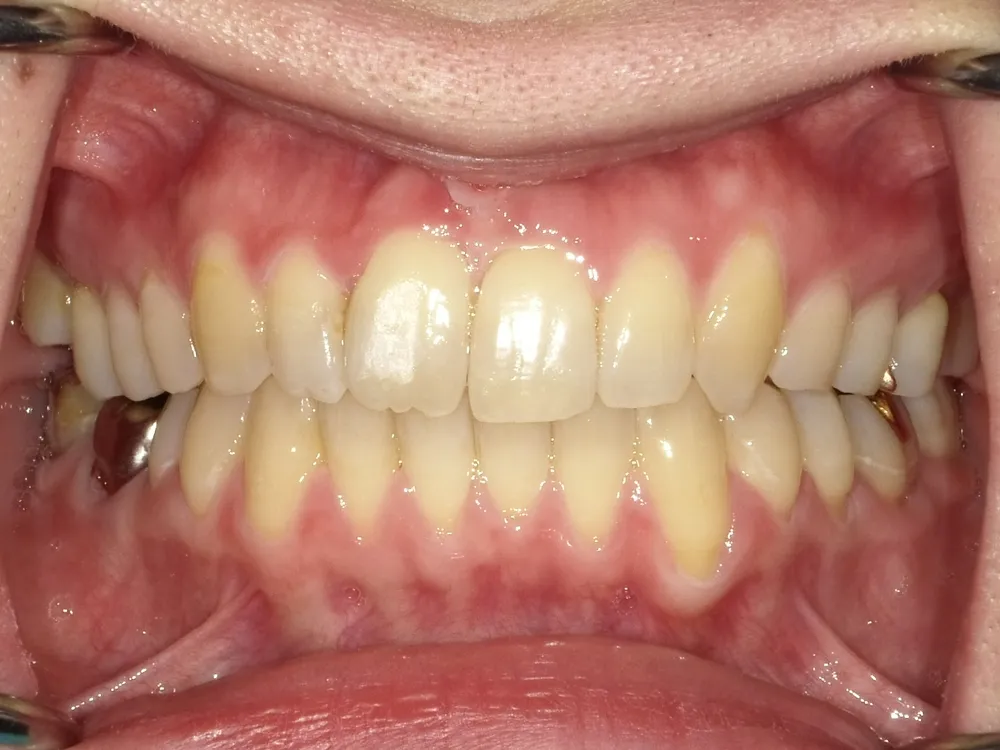 CASE15