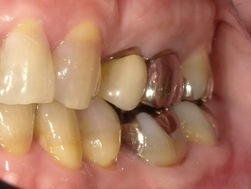 CASE13