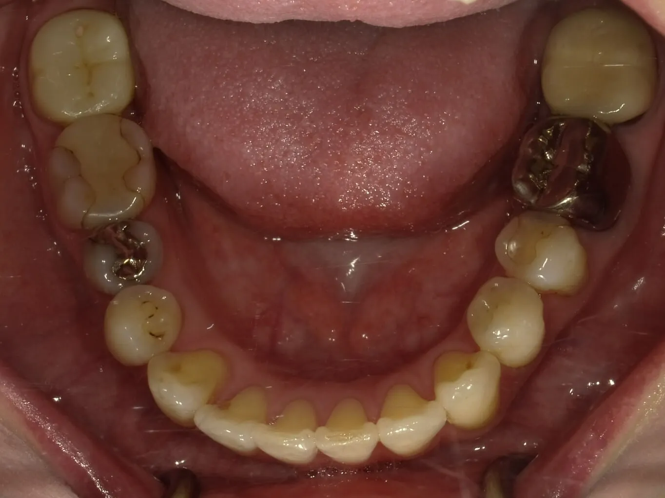 CASE13