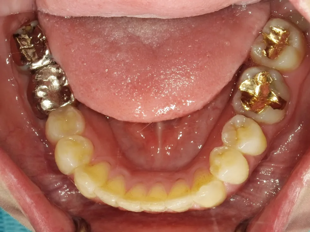 CASE13