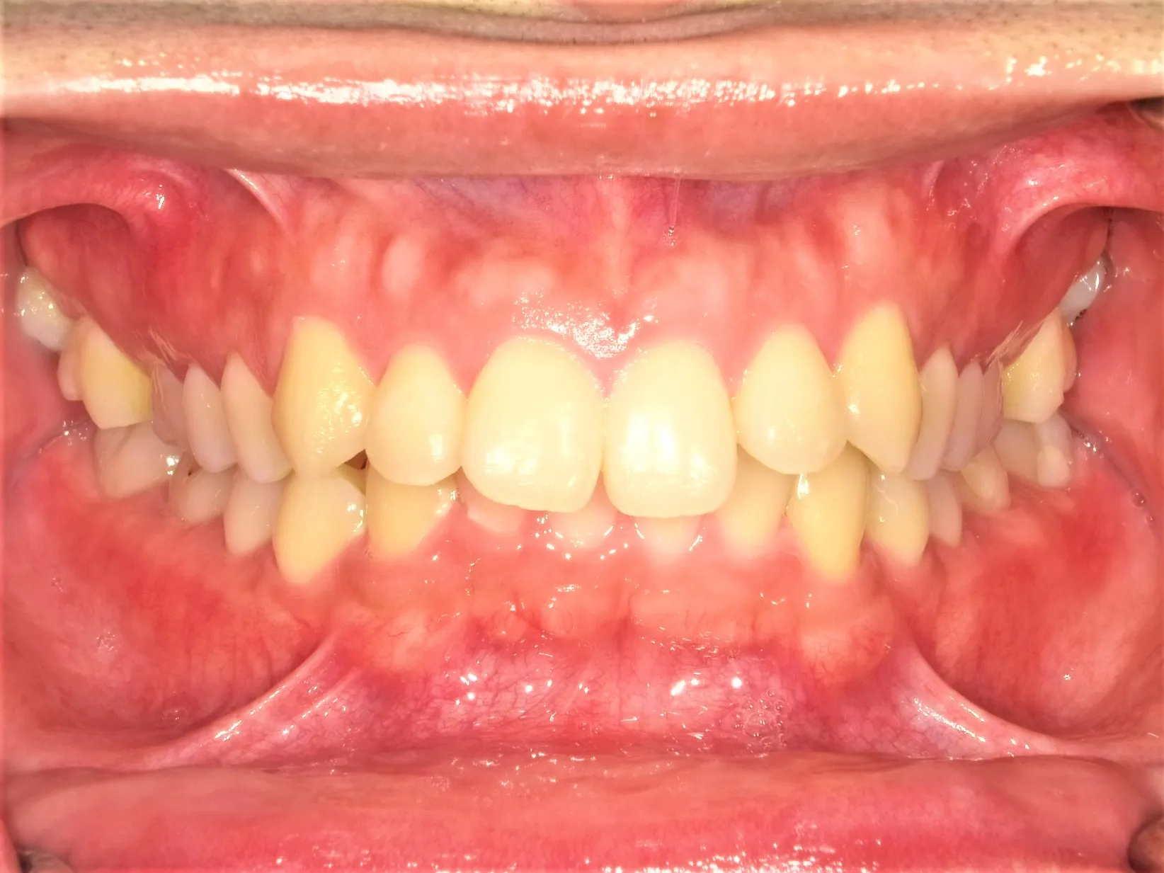 CASE19