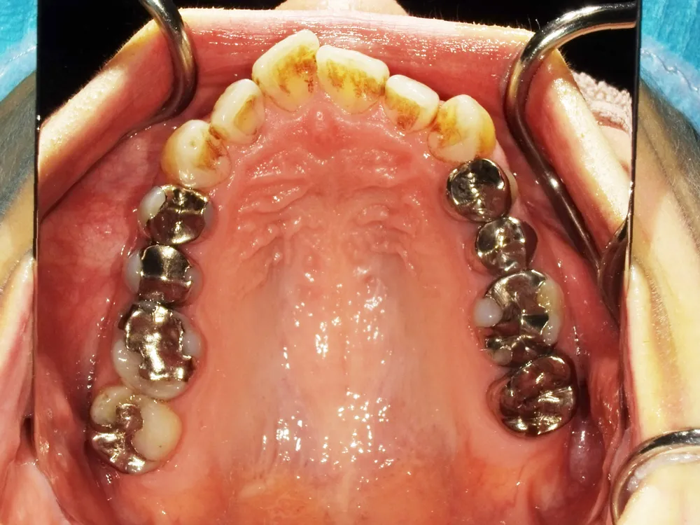 CASE13