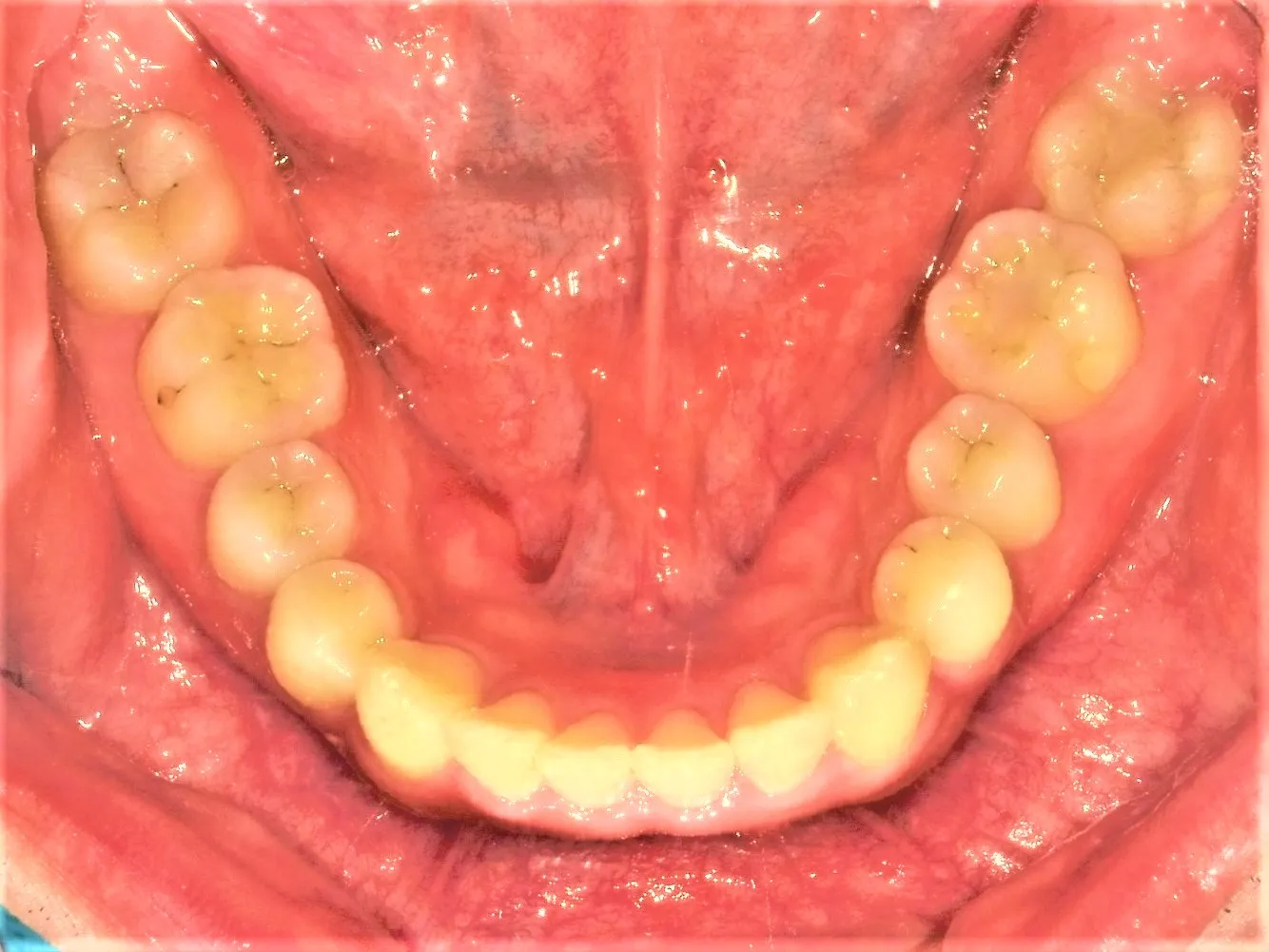 CASE19
