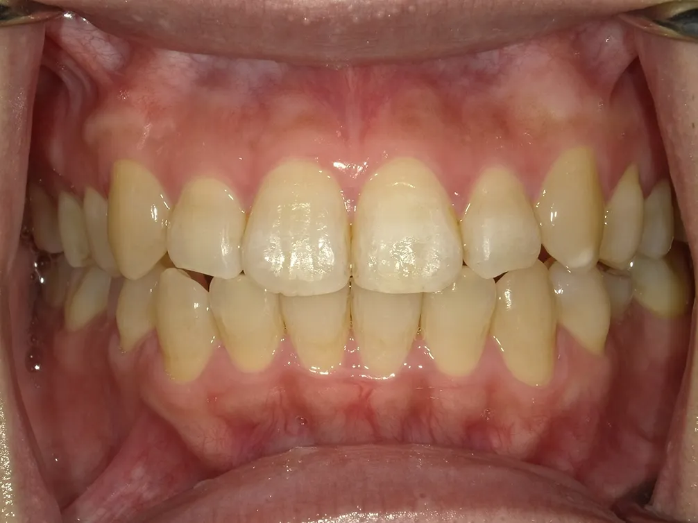 CASE23