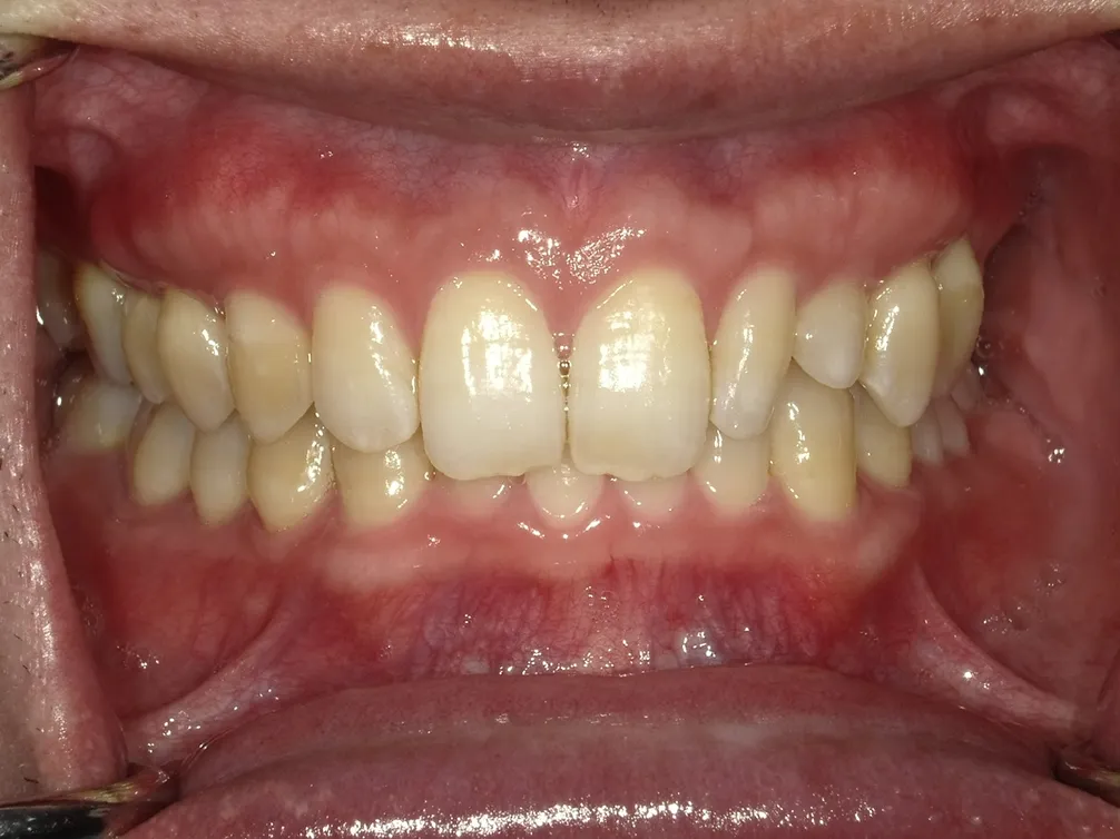 CASE28